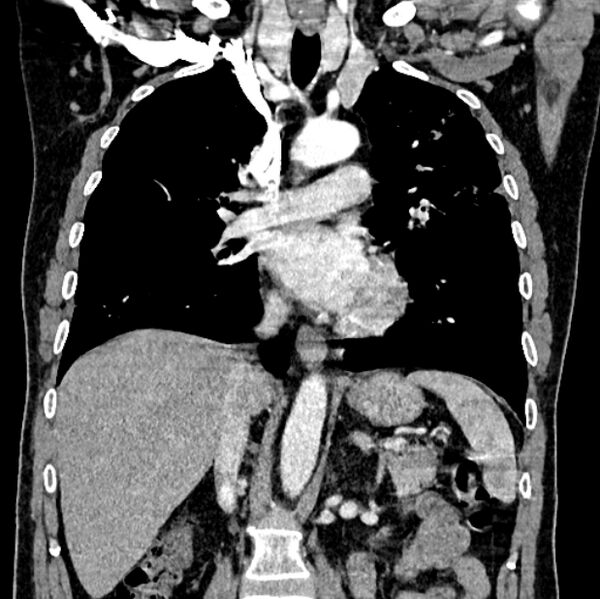 File:Brain metastases - lung cancer primary (Radiopaedia 75060-86116 C+ arterial phase 33).jpg
