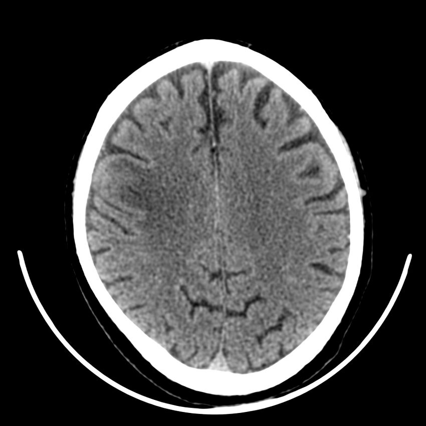 Brain metastasis (Radiopaedia 42617-45760 Axial non-contrast 33).jpg