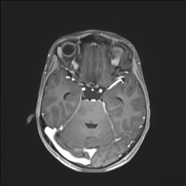 File:Brainstem glioma (Radiopaedia 70548-80674 Axial T1 C+ 61).jpg