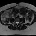 Broad ligament fibroid (Radiopaedia 49135-54241 Axial T2 2).jpg