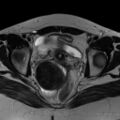 Broad ligament fibroid (Radiopaedia 49135-54241 Axial T2 20).jpg