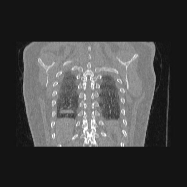 File:Bronchial atresia (Radiopaedia 60685-68439 Coronal lung window 10).jpg