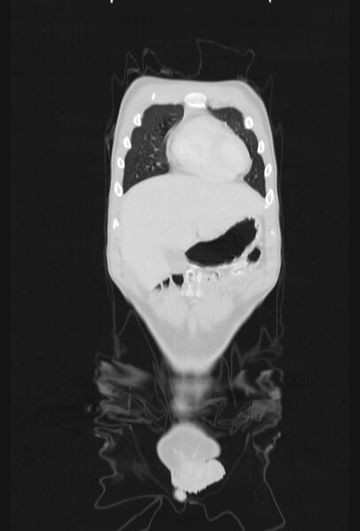 File:Bronchial carcinoid tumor (Radiopaedia 57187-64090 Coronal lung window 9).jpg