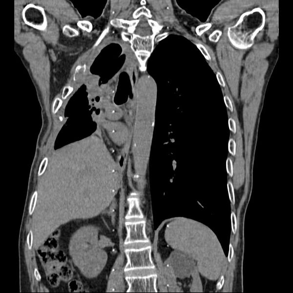 File:Bronchopleural fistula - postoperative complication (Radiopaedia 21020-20947 Coronal non-contrast 18).jpg