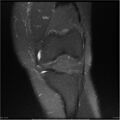 Bucket handle tear - lateral meniscus (Radiopaedia 7246-8187 Coronal T2 fat sat 16).jpg
