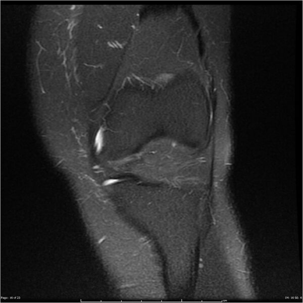 File:Bucket handle tear - lateral meniscus (Radiopaedia 7246-8187 Coronal T2 fat sat 16).jpg