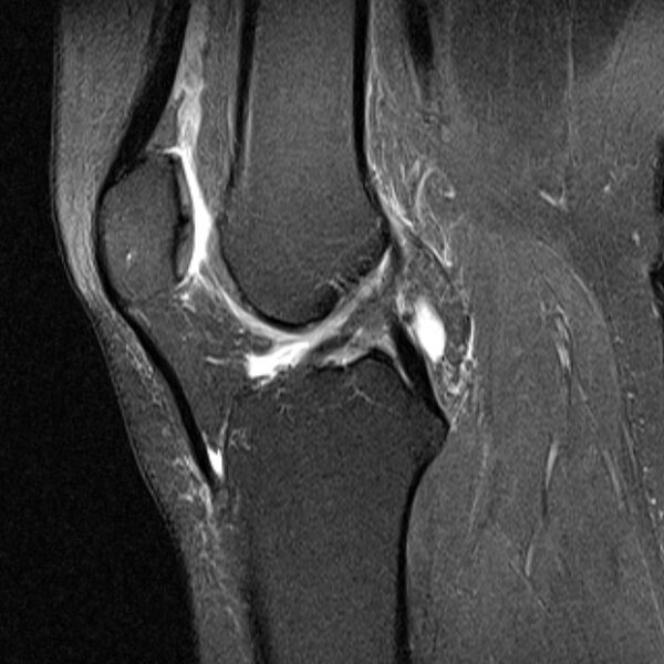 File:Bucket handle tear - medial meniscus (Radiopaedia 79028-91942 Sagittal PD fat sat 12).jpg