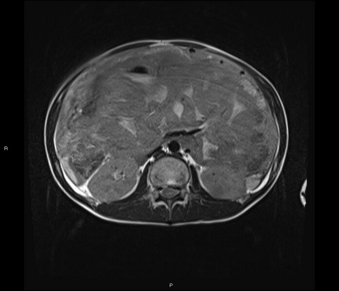 File:Burkitt lymphoma (bowel) (Radiopaedia 68839-78557 Axial T2 27).jpg
