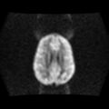 Burkitt lymphoma of the orbit- pre and post chemotherapy (Radiopaedia 31214-31929 Axial DWI 11).jpg