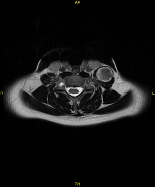 File:C5 nerve sheath tumor (Radiopaedia 85777-101596 Axial T2 49).jpg