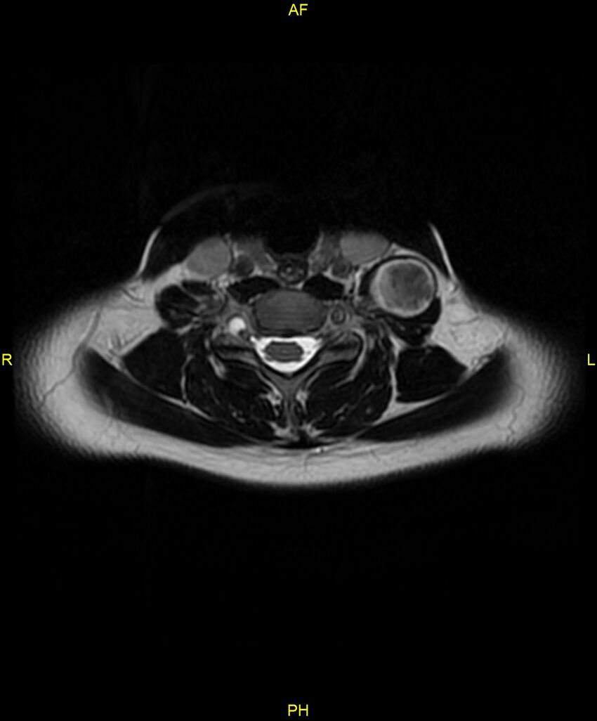 C5 nerve sheath tumor (Radiopaedia 85777-101596 Axial T2 49).jpg