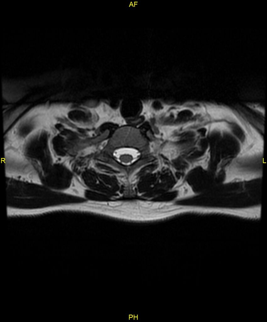 C5 nerve sheath tumor (Radiopaedia 85777-101596 Axial T2 76).jpg