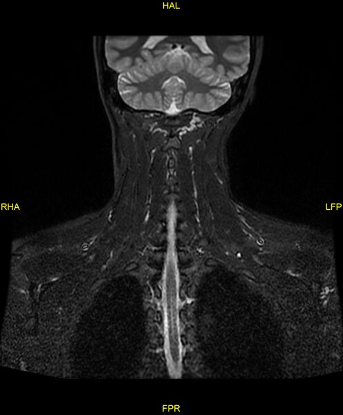 File:C5 nerve sheath tumor (Radiopaedia 85777-101596 Coronal T2 fat sat 16).jpg