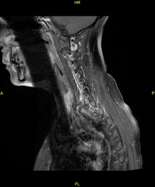 File:C5 nerve sheath tumor (Radiopaedia 85777-101596 F 14).jpg