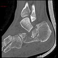 Calcaneal fracture and associated spinal injury (Radiopaedia 17896-17656 Sagittal bone window 5).jpg