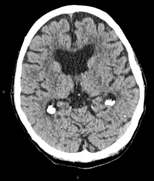File:Calcified cerebral emboli from left ventricular thrombus (Radiopaedia 84420-99758 Axial non-contrast 50).jpg