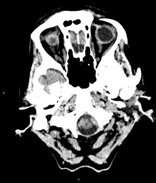 File:Calcified cerebral emboli from left ventricular thrombus (Radiopaedia 84420-99758 Axial non-contrast 81).jpg