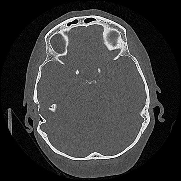 File:Canal up mastoidectomy (Radiopaedia 78108-90638 Axial bone window 112).jpg