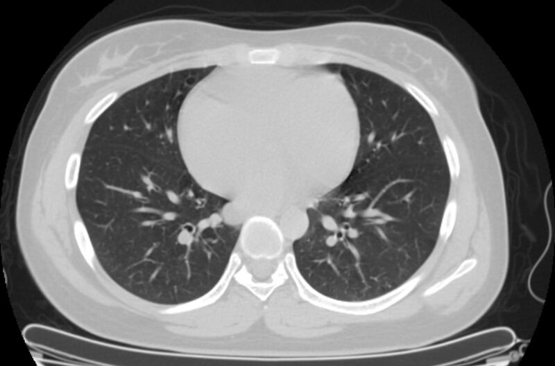 File:Cannonball metastases - uterine choriocarcinoma (Radiopaedia 70137-80173 Axial lung window 66).jpg