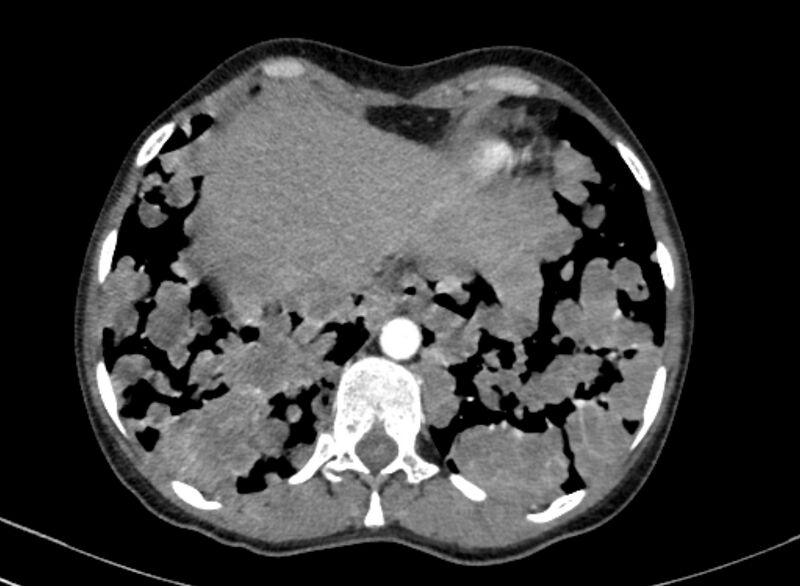 File:Cannonball metastases from breast cancer (Radiopaedia 91024-108569 A 100).jpg