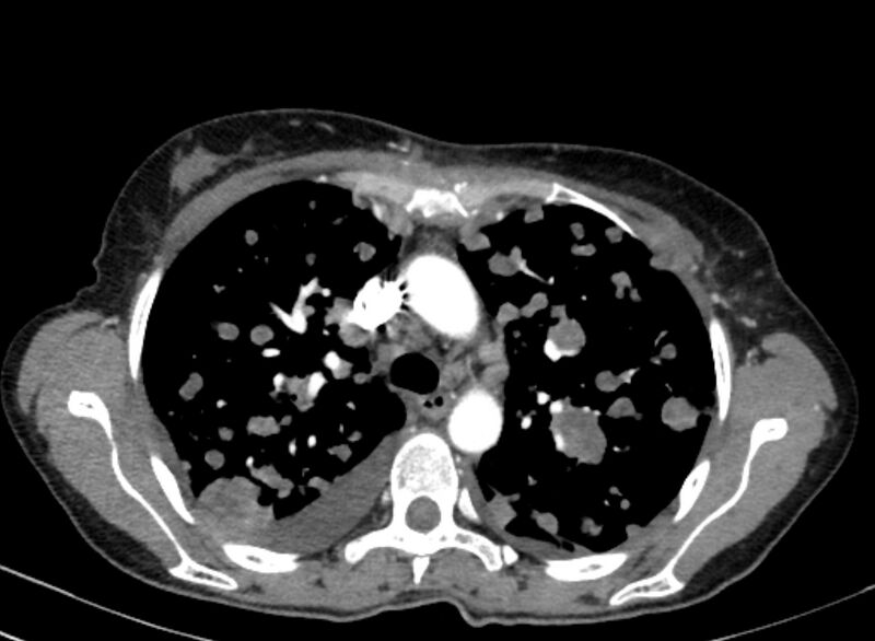 File:Cannonball metastases from breast cancer (Radiopaedia 91024-108569 A 42).jpg