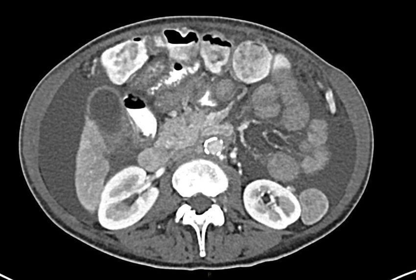 Carcinoid mesenteric tumor complicated by chylous ascites (Radiopaedia 76312-87953 A 32).jpg