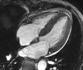 Cardiac amyloidosis (Radiopaedia 39736-42124 D 20).jpg