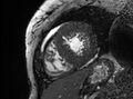 Cardiac amyloidosis (Radiopaedia 61600-69579 Short axis bSSFP 120).jpg