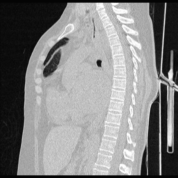 File:Cardiogenic pulmonary edema (Radiopaedia 29213-29609 Sagittal lung window 51).jpg