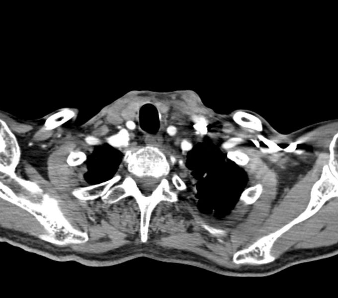 File:Carotid artery pseudoaneurysm (Radiopaedia 84030-99259 C 72).jpg
