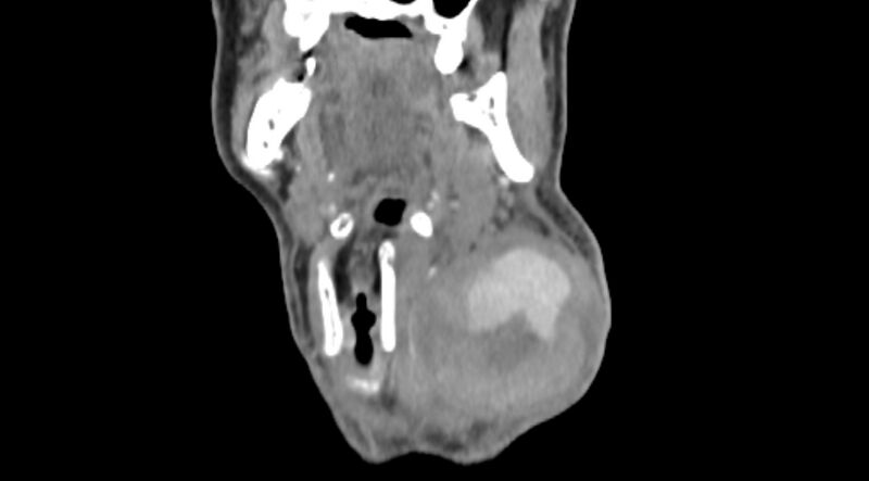 File:Carotid artery pseudoaneurysm (Radiopaedia 84030-99259 D 19).jpg