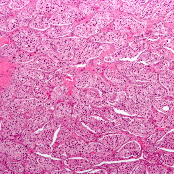 File:Carotid body tumor (histology) (Radiopaedia 7681-8498 B 1).jpg