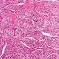 Carotid body tumor (histology) (Radiopaedia 7681-8498 C 1).jpg
