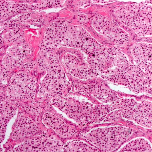 File:Carotid body tumor (histology) (Radiopaedia 7681-8498 C 1).jpg