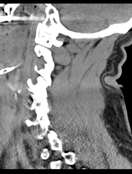 File:Cavernoma of cervical cord (Radiopaedia 50838-56346 B 27).png