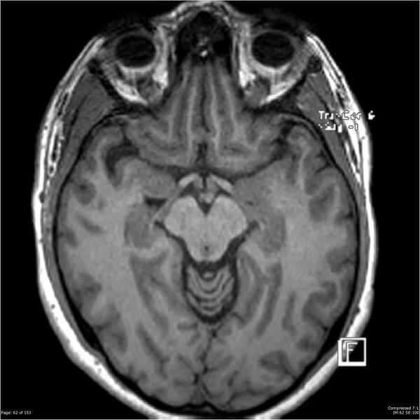 File:Cavernous malformation (cavernous angioma or cavernoma) (Radiopaedia 36675-38237 Axial T1 51).jpg