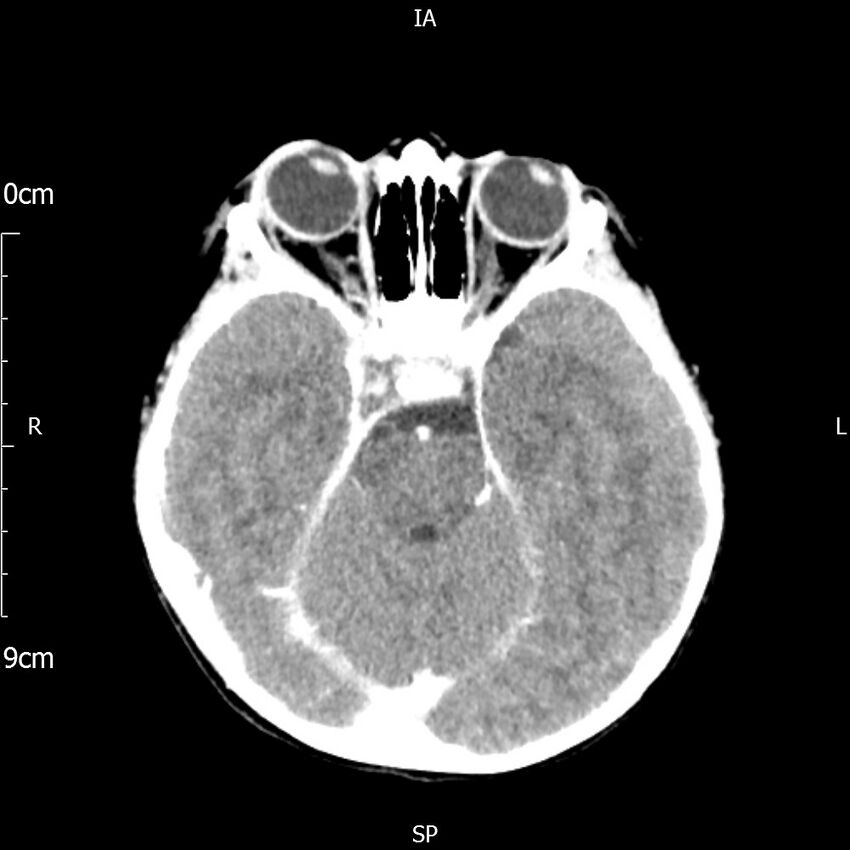 Cavernous sinus thrombosis (Radiopaedia 79414-92510 Axial Brain 81).jpg