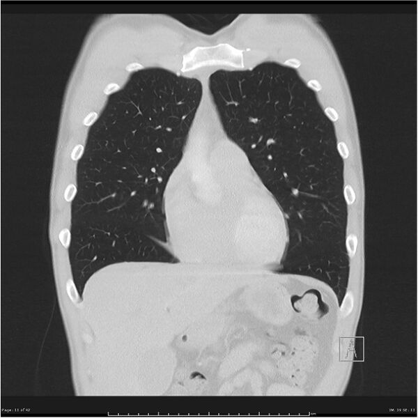 File:Cavitating lung cancer (Radiopaedia 25796-25945 lung window 11).jpg