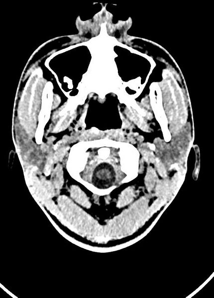 File:Cavum septum pellucidum and cavum vergae (Radiopaedia 77797-90060 Axial Brain Window 3).jpg