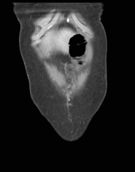 File:Cecum hernia through the foramen of Winslow (Radiopaedia 46634-51112 B 7).png