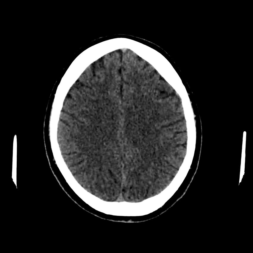 Central nervous system Langerhans cell histiocytosis (Radiopaedia 65728-74878 Axial non-contrast 37).jpg