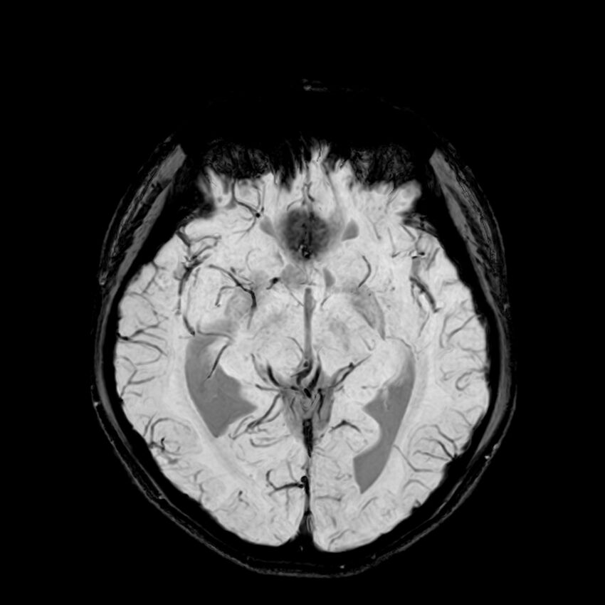 Central neurocytoma (Radiopaedia 79320-92380 Axial SWI 61).jpg