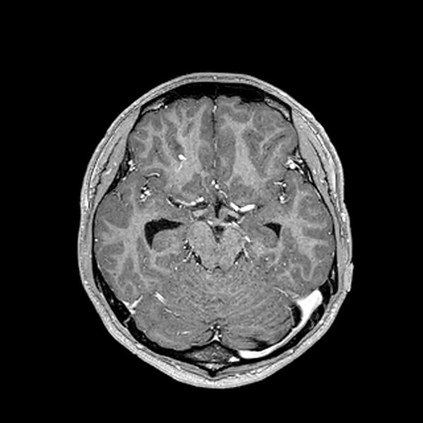 File:Central neurocytoma (Radiopaedia 79320-92380 Axial T1 C+ 102).jpg