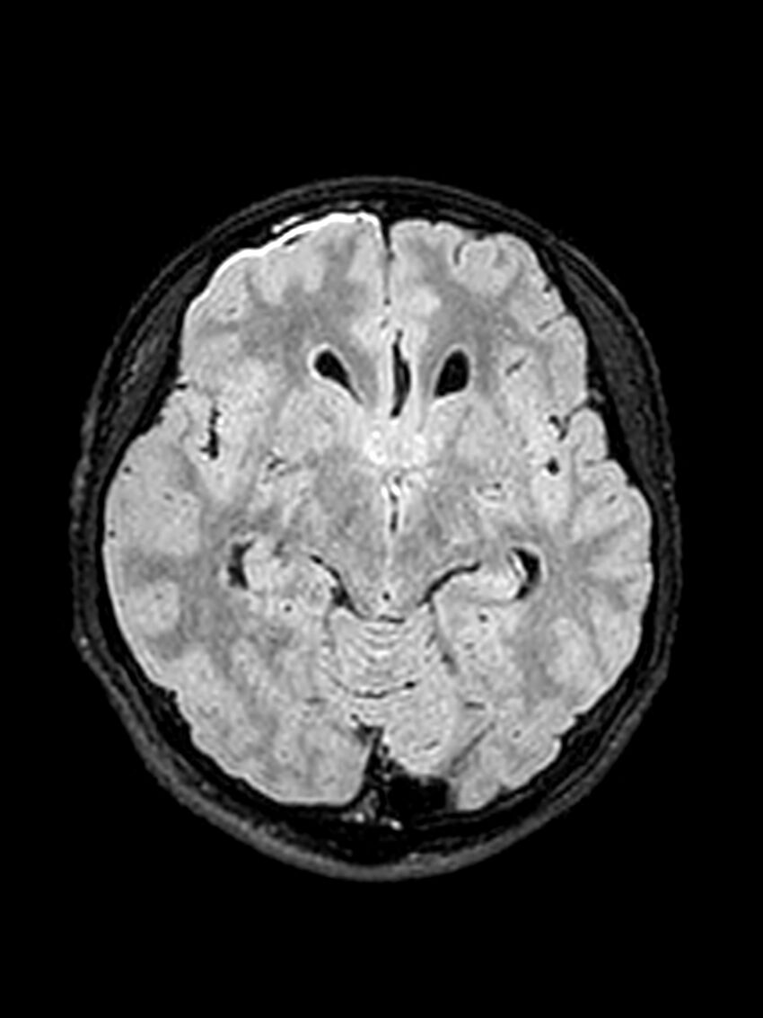 Central neurocytoma (Radiopaedia 79320-92381 Axial FLAIR 100).jpg