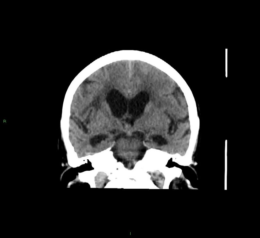Cerebellar hemorrhage (Radiopaedia 58793-66027 Coronal non-contrast 38).jpg