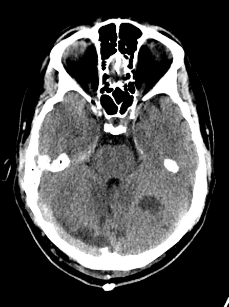 File:Cerebellar infarct due to vertebral artery dissection with posterior fossa decompression (Radiopaedia 82779-97032 Axial non-contrast 9).png