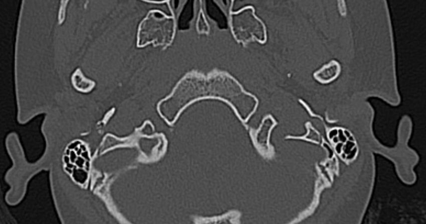 Cerebellopontine angle lipoma (Radiopaedia 57303-64242 Axial bone window 1).jpg