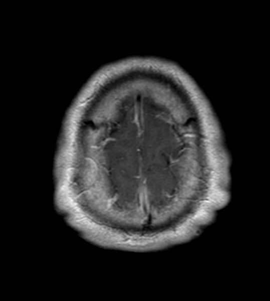 File:Cerebellopontine angle meningioma (Radiopaedia 24459-24764 Axial T1 C+ 23).jpg