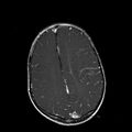 Cerebral abscess post cardiac surgery (Radiopaedia 27244-27420 Axial T1 C+ 15).jpg