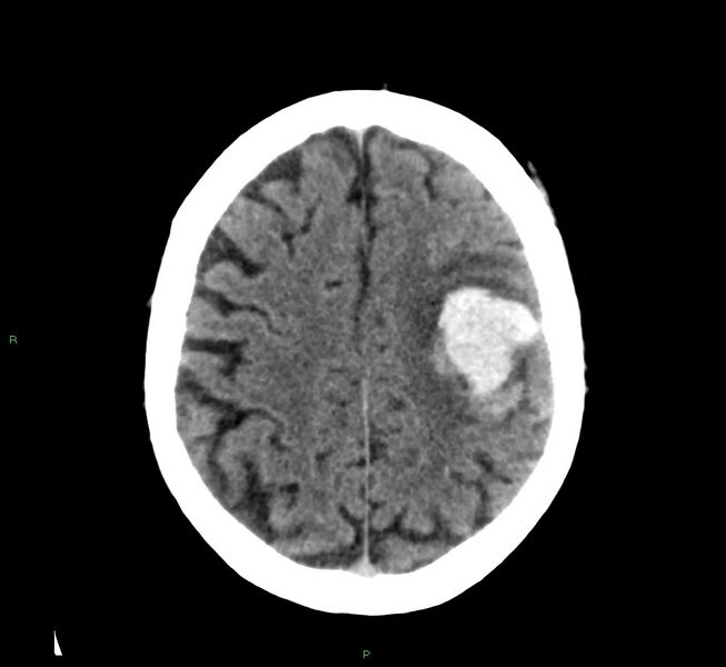 File:Cerebral amyloid angiopathy-associated lobar intracerebral hemorrhage (Radiopaedia 58376-65511 Axial non-contrast 18).jpg